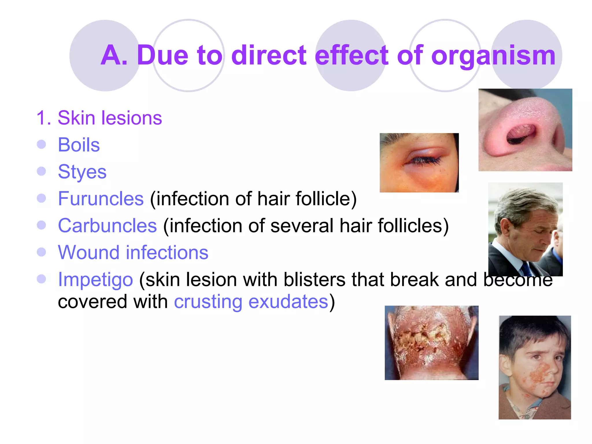 A. Due to direct effect of organism 1. Skin lesions Boils Styes Furuncles   (infection of hair follicle) Carbuncles   (infection of several hair follicles) Wound infections   Impetigo  (skin lesion with blisters that break and become covered with  crusting exudates ) 