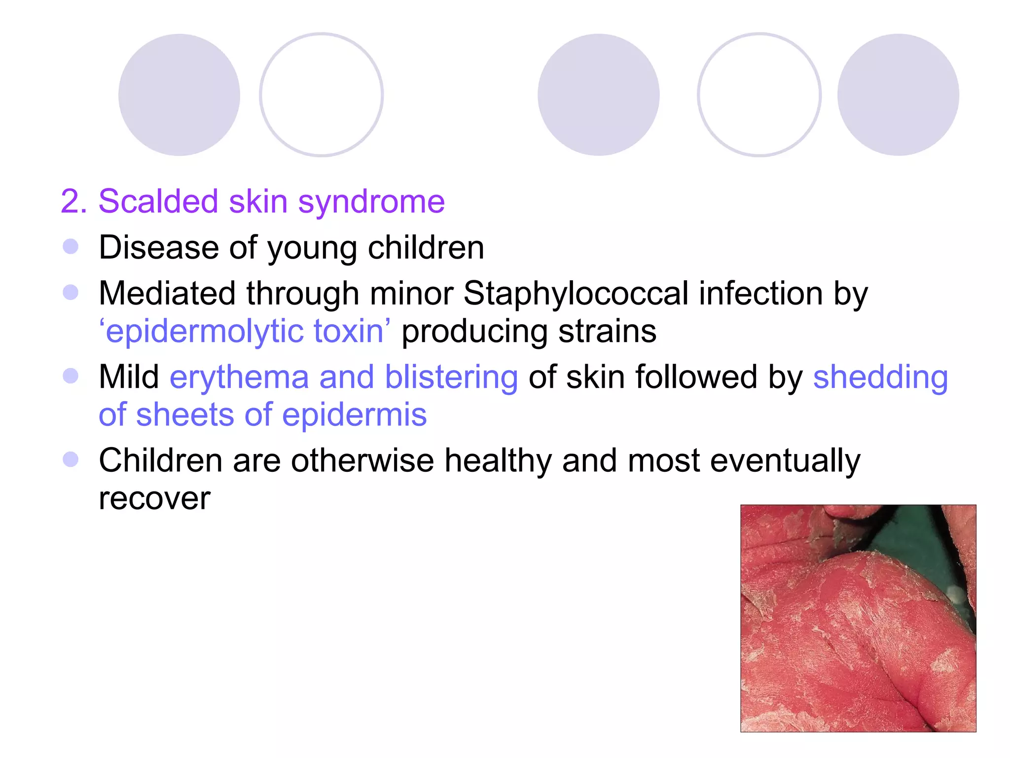 2. Scalded skin syndrome Disease of young children Mediated through minor Staphylococcal infection by  ‘epidermolytic toxin’   producing strains Mild  erythema and blistering  of skin followed by  shedding of sheets of epidermis Children are otherwise healthy and most eventually recover 