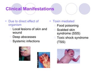 Clinical Manifestations Due to direct effect of organism Local lesions of skin and wound Deep abscesses Systemic infections Toxin mediated Food poisoning Scalded skin syndrome (SSS) Toxic shock syndrome (TSS) 