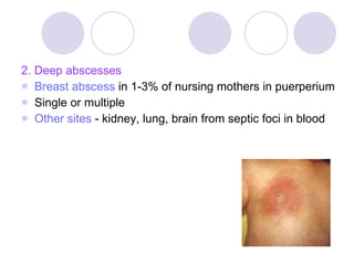 2. Deep abscesses Breast abscess  in 1-3% of nursing mothers in puerperium Single or multiple Other sites  - kidney, lung, brain from septic foci in blood 