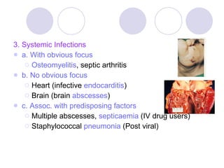 3. Systemic Infections a. With obvious focus Osteomyelitis , septic arthritis b. No obvious focus Heart (infective  endocarditis ) Brain (brain  abscesses ) c.   Assoc. with predisposing factors   Multiple abscesses,  septicaemia  (IV drug users) Staphylococcal  pneumonia  (Post viral) 
