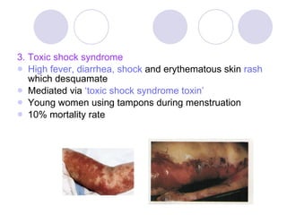 3. Toxic shock syndrome High fever, diarrhea, shock  and erythematous skin  rash  which desquamate Mediated via  ‘toxic shock syndrome toxin’ Young women using tampons during menstruation 10% mortality rate 