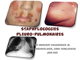 STAPHYLOCOCCIES
PLEURO-PULMONAIRES

        Dr Innocent kashongwe M.
    DES pneumologie, CHNU Fann,Dakar
                 Juin 2011
 