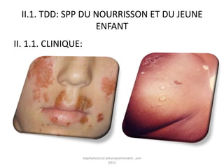 II.1. TDD: SPP DU NOURRISSON ET DU JEUNE
                    ENFANT
II. 1.1. CLINIQUE:




                     staphylococcie pleuropulmonaire , juin
                                      2011
 