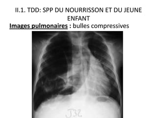 II.1. TDD: SPP DU NOURRISSON ET DU JEUNE
                    ENFANT
Images pulmonaires : bulles compressives




               staphylococcie pleuropulmonaire , juin
                                2011
 