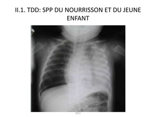 II.1. TDD: SPP DU NOURRISSON ET DU JEUNE
                  ENFANT




             staphylococcie pleuropulmonaire , juin
                              2011
 