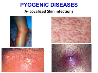 PYOGENIC DISEASES
A- Localized Skin infections

 
