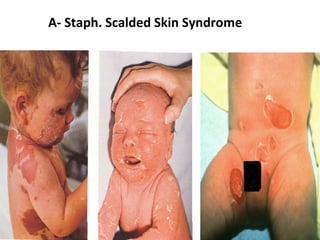 A- Staph. Scalded Skin Syndrome

 