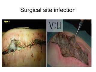 Surgical site infection

 