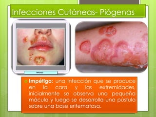 Infecciones Cutáneas- Piógenas




   Impétigo: una infección que se produce
    en la cara y las extremidades,
    inicialmente se observa una pequeña
    mácula y luego se desarrolla una pústula
    sobre una base eritematosa.
 