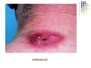 CARBUNCLES
 