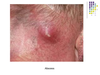 Abscess
 