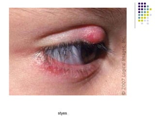 styes
 
