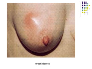 Brest abscess
 