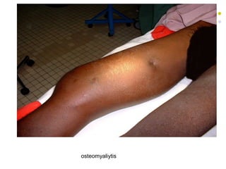 osteomyaliytis
 