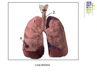 Lung abscess
 