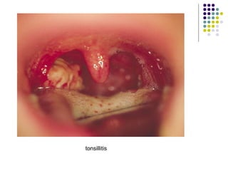 tonsillitis
 