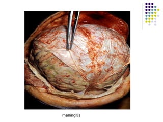meningitis
 