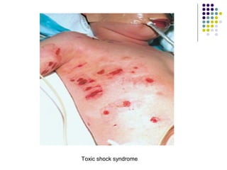Toxic shock syndrome
 