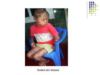 Scaled skin disease
 