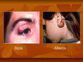 Styes Abscess
 