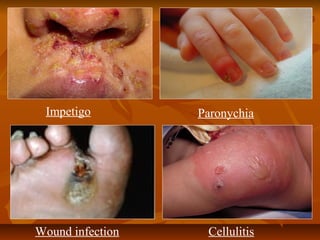 Impetigo Paronychia
CellulitisWound infection
 