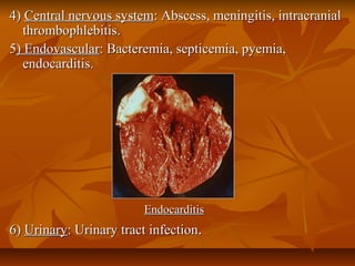 4)4) Central nervous systemCentral nervous system: Abscess, meningitis, intracranial: Abscess, meningitis, intracranial
thrombophlebitis.thrombophlebitis.
55) Endovascular) Endovascular: Bacteremia, septicemia, pyemia,: Bacteremia, septicemia, pyemia,
endocarditis.endocarditis.
EndocarditisEndocarditis
6)6) UrinaryUrinary: Urinary tract infection: Urinary tract infection..
 
