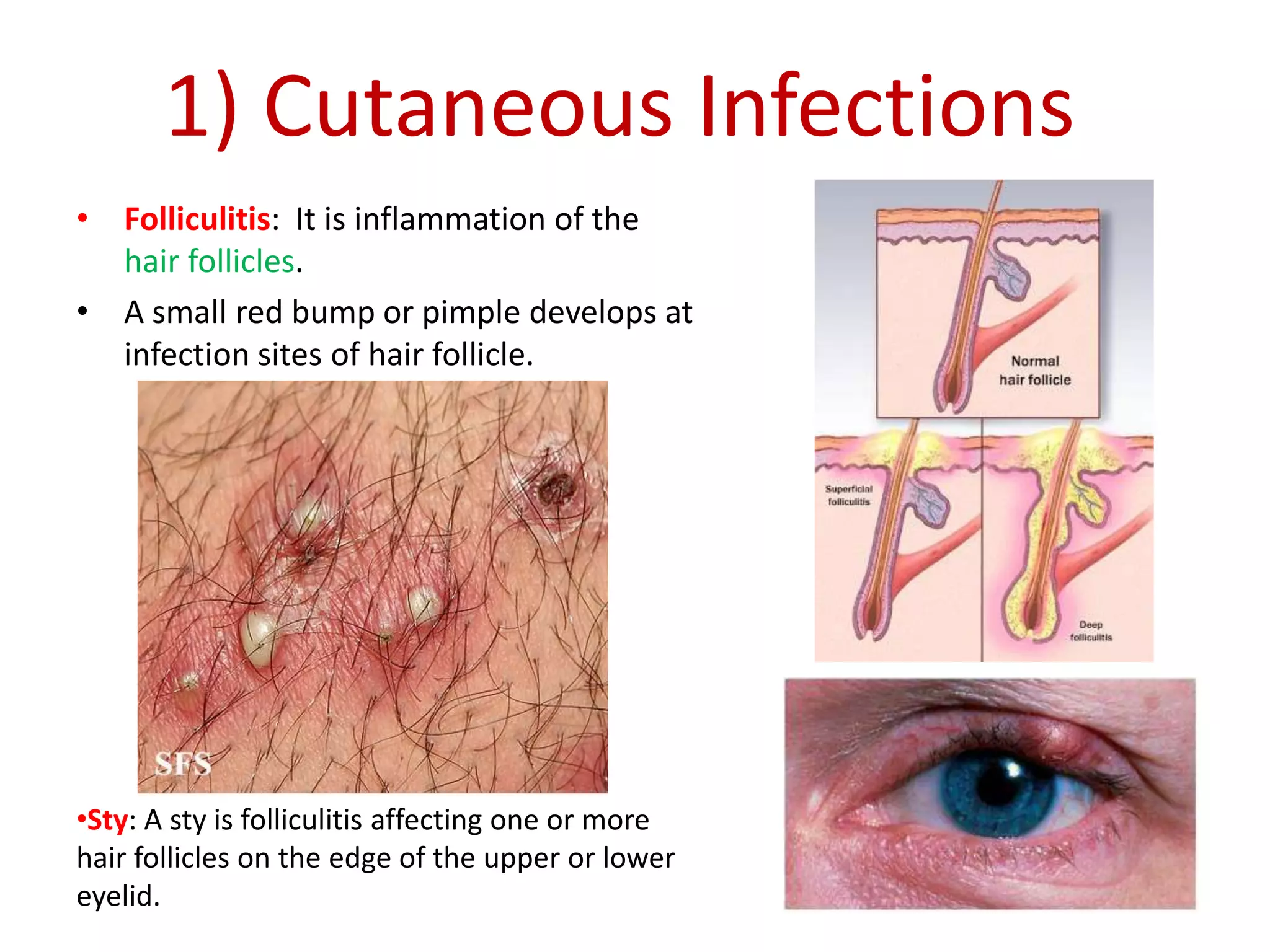 1) Cutaneous Infections
• Folliculitis: It is inflammation of the
hair follicles.
• A small red bump or pimple develops at
infection sites of hair follicle.
•Sty: A sty is folliculitis affecting one or more
hair follicles on the edge of the upper or lower
eyelid.
 