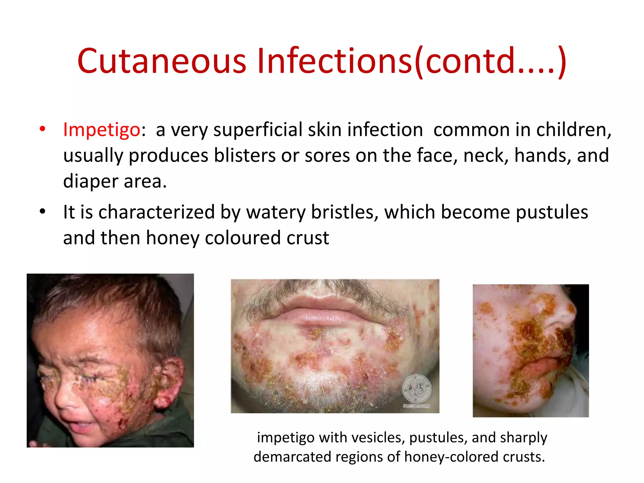 Cutaneous Infections(contd....)
• Impetigo: a very superficial skin infection common in children,
usually produces blisters or sores on the face, neck, hands, and
diaper area.
• It is characterized by watery bristles, which become pustules
and then honey coloured crust
impetigo with vesicles, pustules, and sharply
demarcated regions of honey-colored crusts.
 