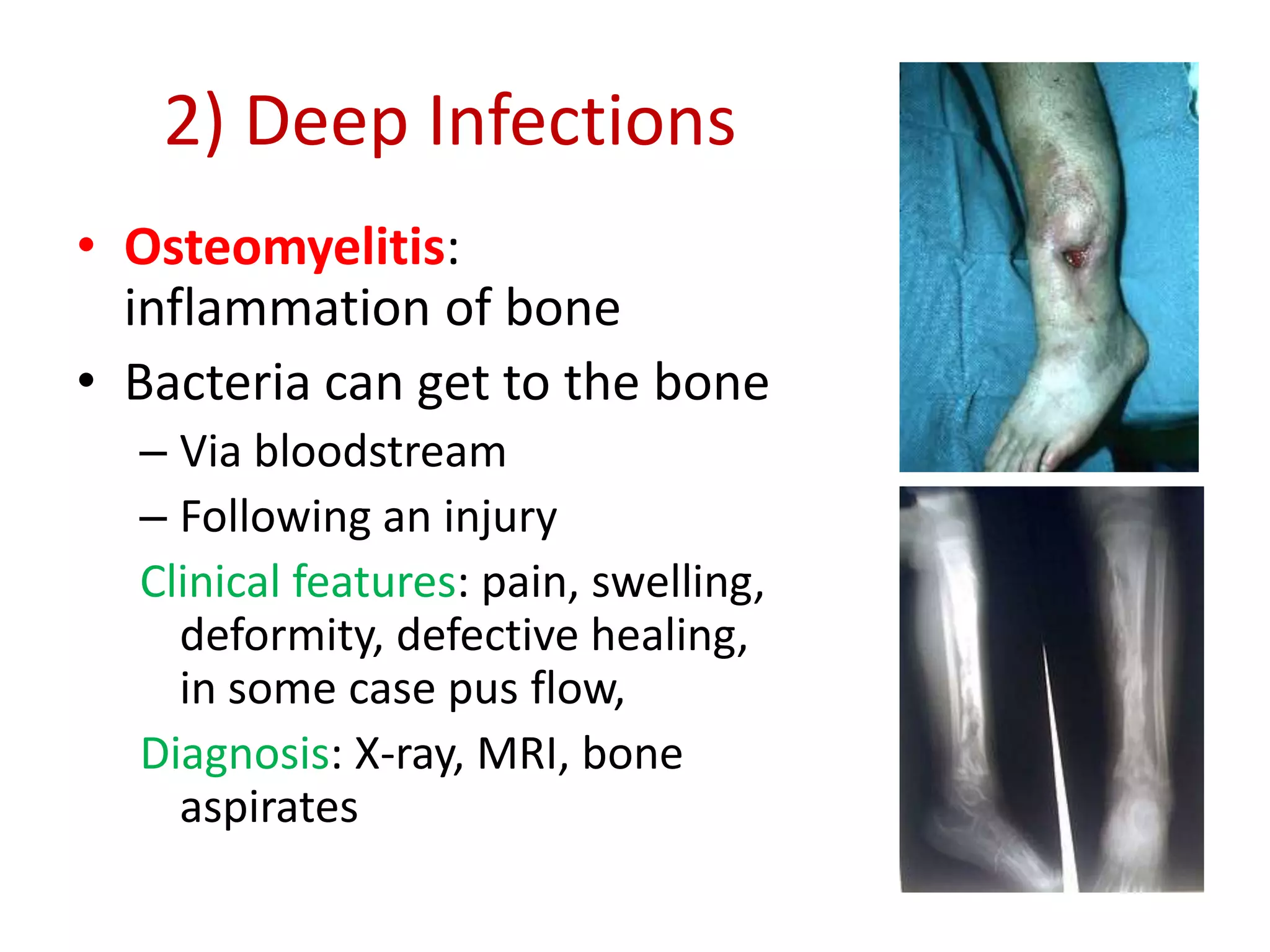 2) Deep Infections
• Osteomyelitis:
inflammation of bone
• Bacteria can get to the bone
– Via bloodstream
– Following an injury
Clinical features: pain, swelling,
deformity, defective healing,
in some case pus flow,
Diagnosis: X-ray, MRI, bone
aspirates
 