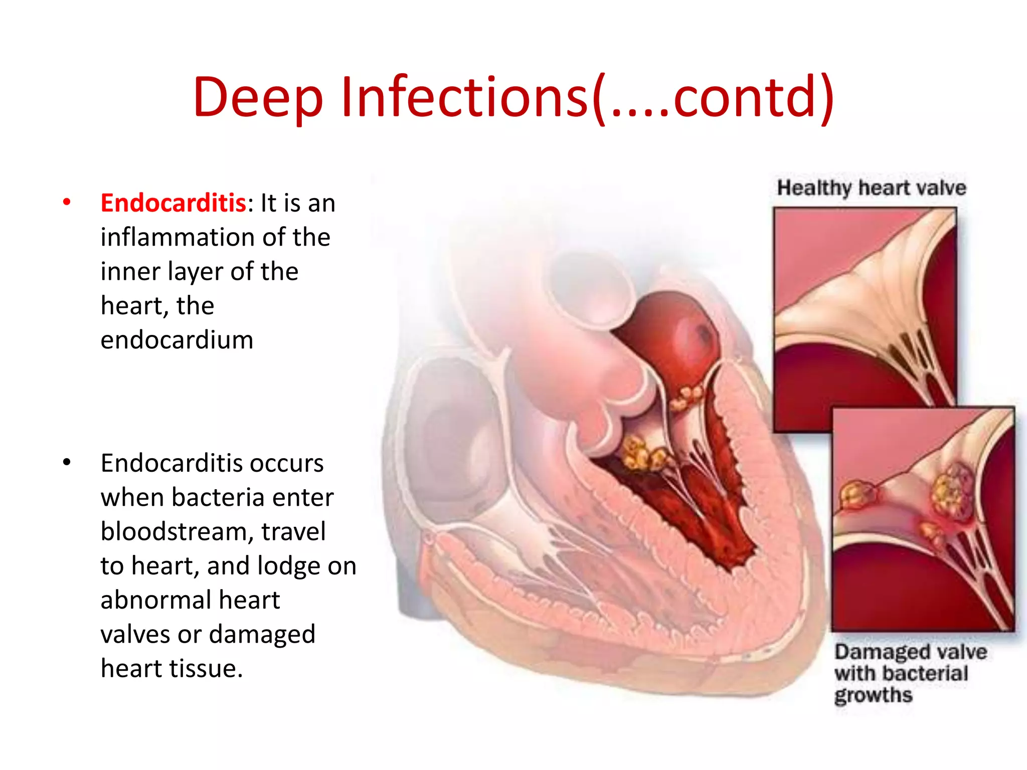 Deep Infections(....contd)
• Endocarditis: It is an
inflammation of the
inner layer of the
heart, the
endocardium
• Endocarditis occurs
when bacteria enter
bloodstream, travel
to heart, and lodge on
abnormal heart
valves or damaged
heart tissue.
 
