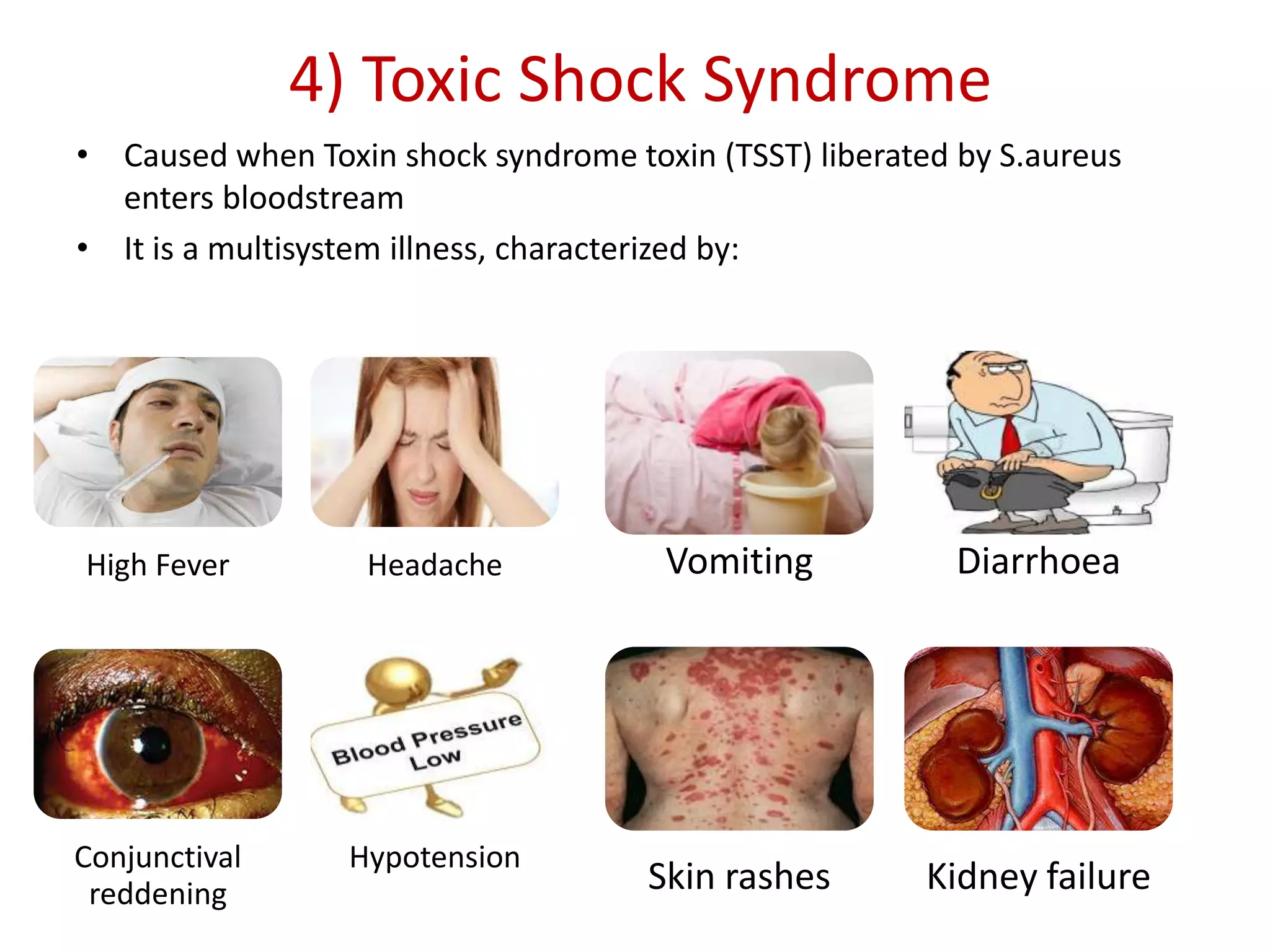 4) Toxic Shock Syndrome
• Caused when Toxin shock syndrome toxin (TSST) liberated by S.aureus
enters bloodstream
• It is a multisystem illness, characterized by:
Vomiting Diarrhoea
Skin rashes Kidney failure
High Fever Headache
Conjunctival
reddening
Hypotension
 