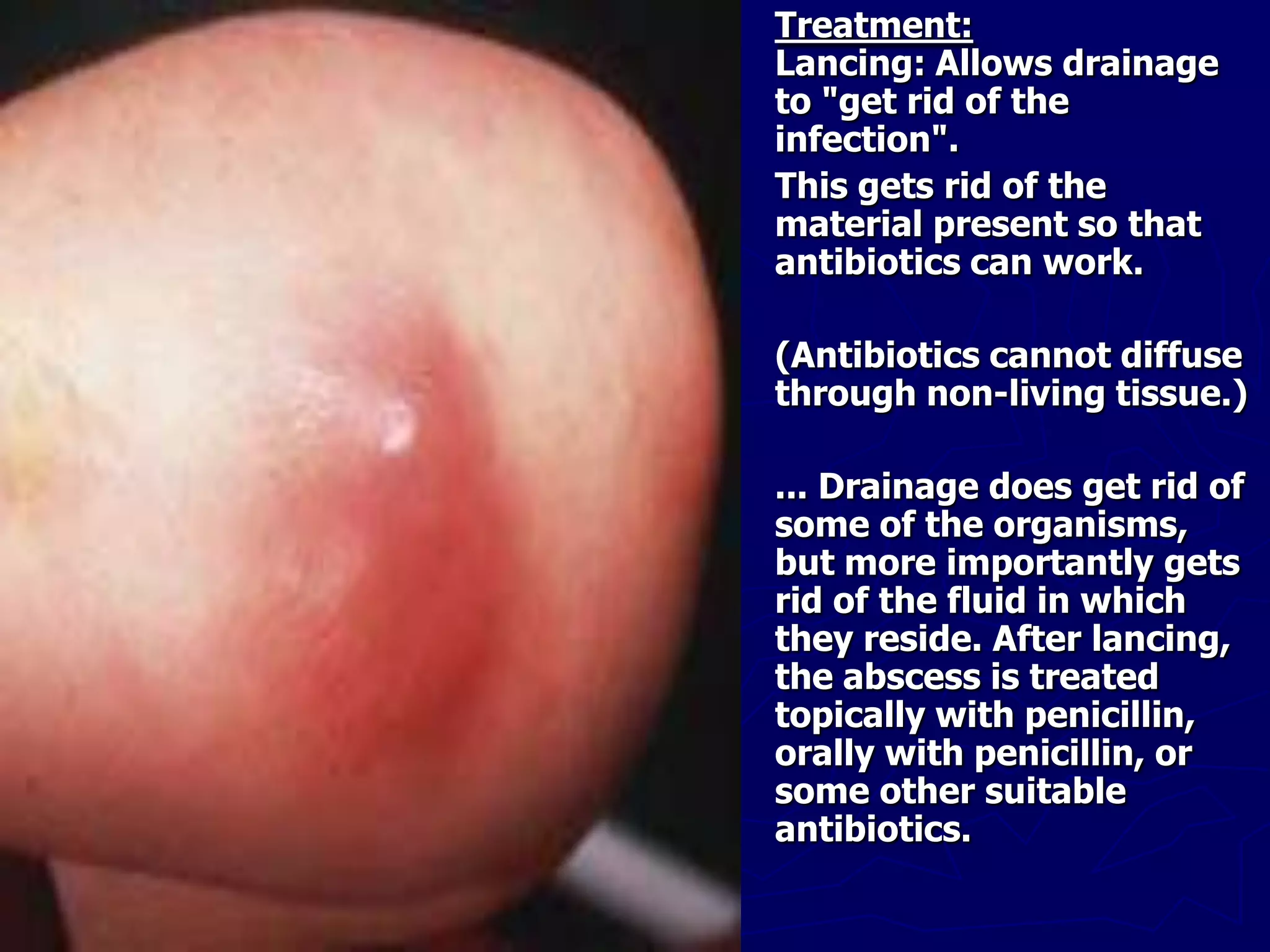 Treatment:
Lancing: Allows drainage
to "get rid of the
infection".
This gets rid of the
material present so that
antibiotics can work.
(Antibiotics cannot diffuse
through non-living tissue.)
... Drainage does get rid of
some of the organisms,
but more importantly gets
rid of the fluid in which
they reside. After lancing,
the abscess is treated
topically with penicillin,
orally with penicillin, or
some other suitable
antibiotics.
 