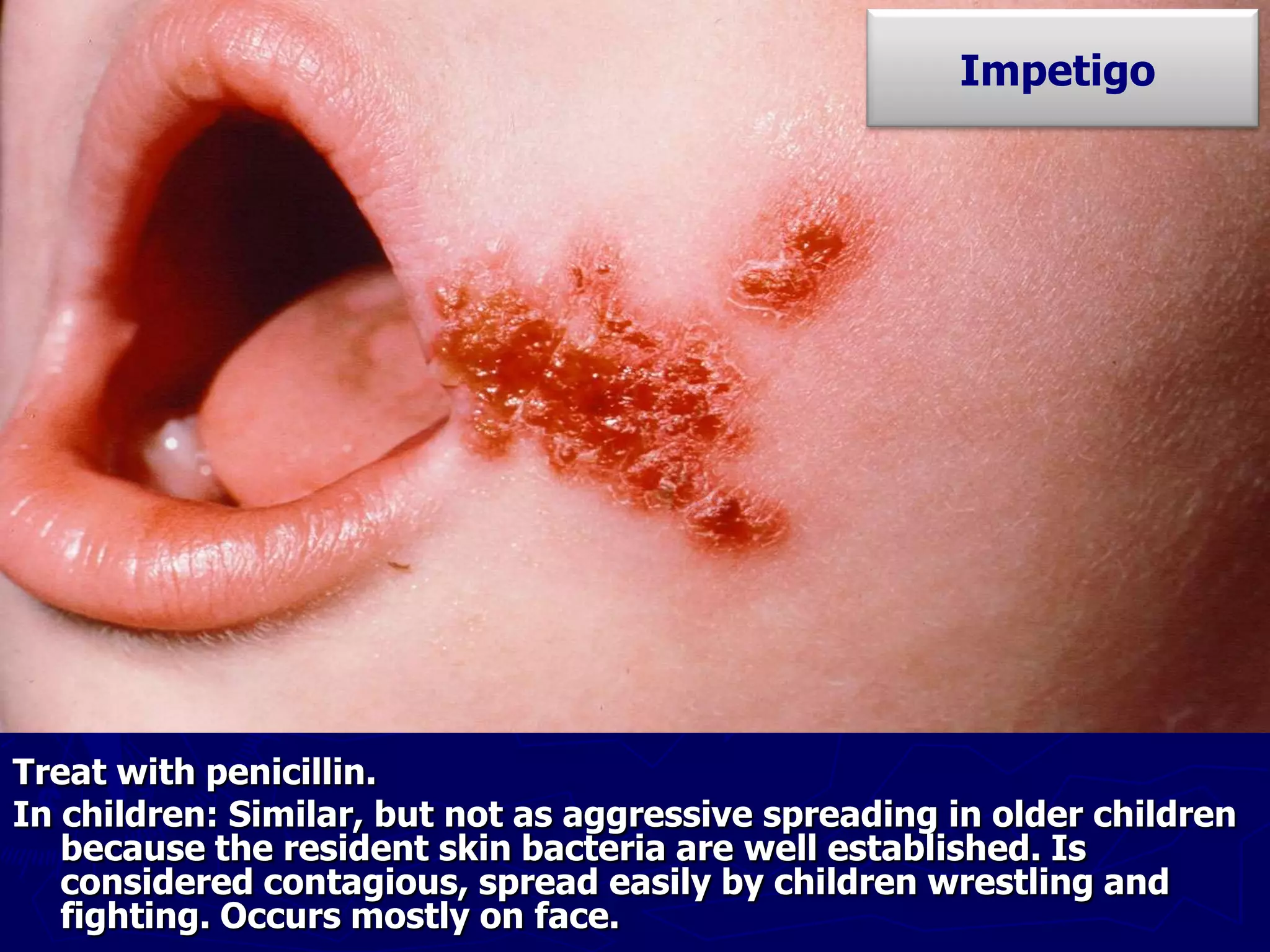 Treat with penicillin.
In children: Similar, but not as aggressive spreading in older children
because the resident skin bacteria are well established. Is
considered contagious, spread easily by children wrestling and
fighting. Occurs mostly on face.
Impetigo
 