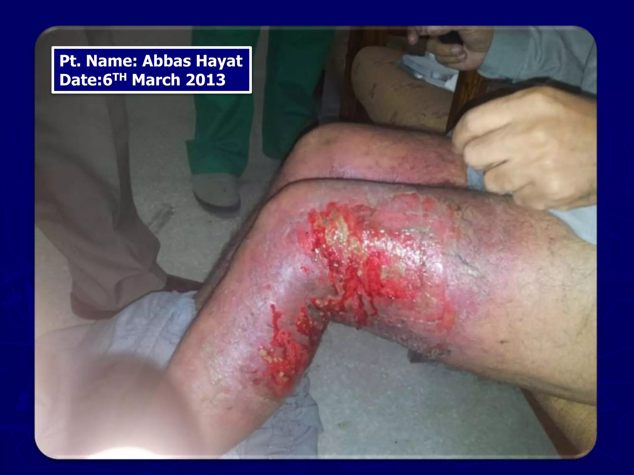 Pt. Name: Abbas Hayat
Date:6TH March 2013
 