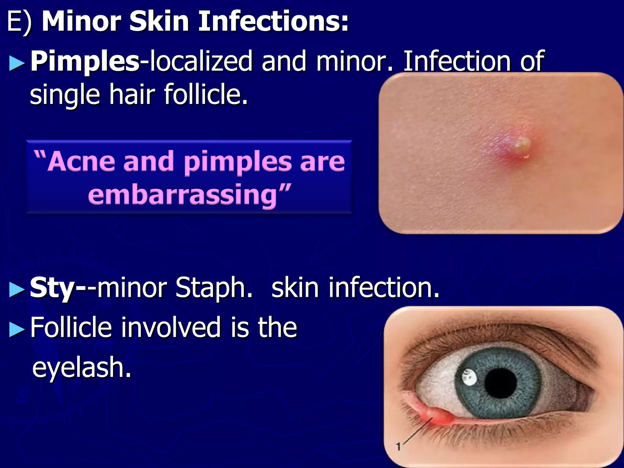 E) Minor Skin Infections:
►Pimples-localized and minor. Infection of
single hair follicle.
►Sty--minor Staph. skin infection.
►Follicle involved is the
eyelash.
“Acne and pimples are
embarrassing”
 
