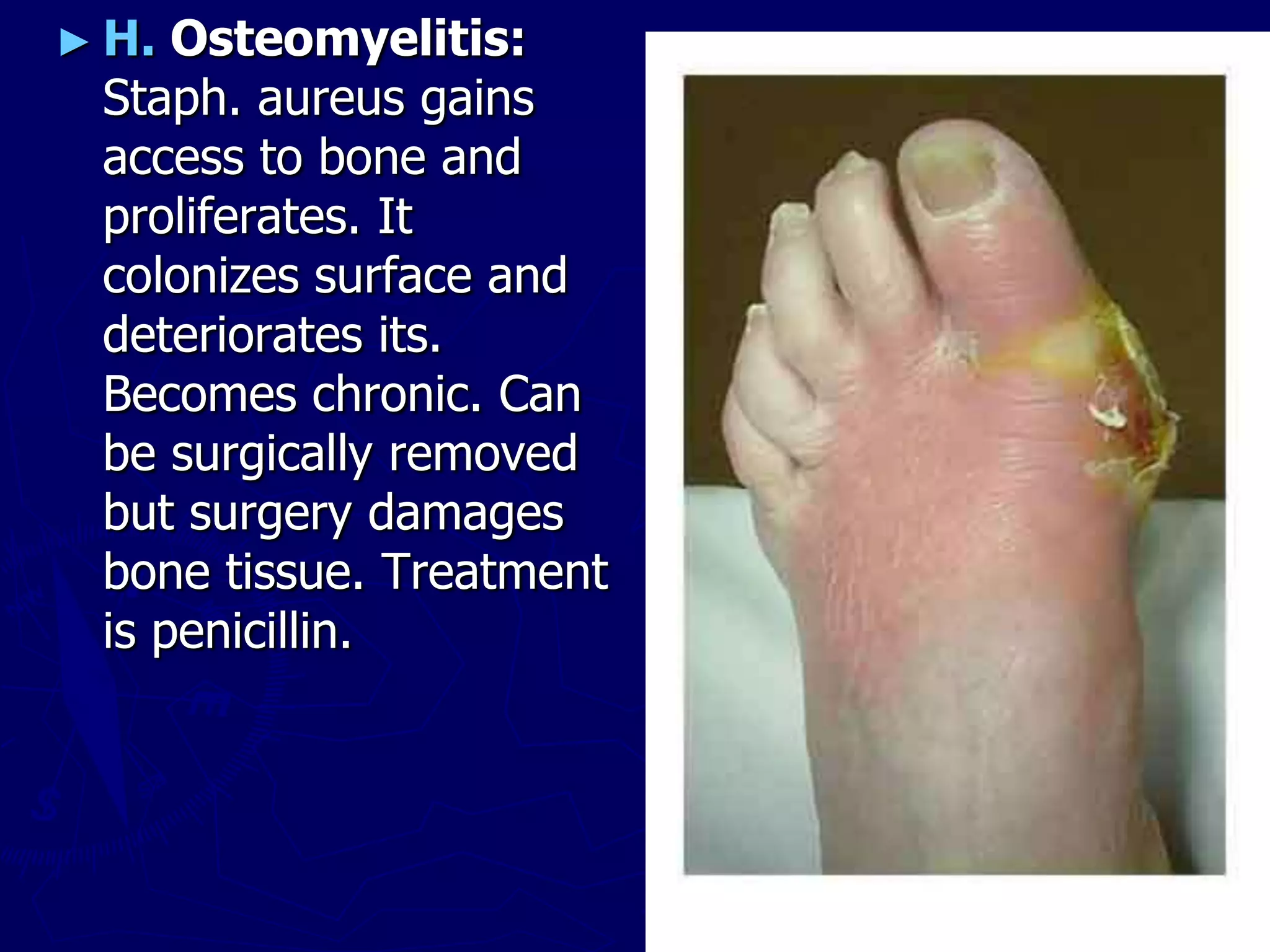 ► H. Osteomyelitis:
Staph. aureus gains
access to bone and
proliferates. It
colonizes surface and
deteriorates its.
Becomes chronic. Can
be surgically removed
but surgery damages
bone tissue. Treatment
is penicillin.
 