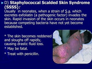 ►D) Staphylococcal Scalded Skin Syndrome
(SSSS):
Usually in neonates, when a strain of S.a. which
excretes exfoliatin (a pathogenic factor) invades the
skin. Rapid invasion of the skin occurs in neonates
because competing bacteria have not yet become
established.
* The skin becomes reddened
and sloughs off rapidly, causing
causing drastic fluid loss.
* May be fatal.
* Treat with penicillin.
 