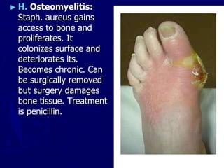► H. Osteomyelitis:
Staph. aureus gains
access to bone and
proliferates. It
colonizes surface and
deteriorates its.
Becomes chronic. Can
be surgically removed
but surgery damages
bone tissue. Treatment
is penicillin.
 