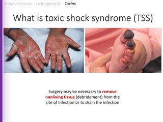 What is toxic shock syndrome (TSS)
Surgery may be necessary to remove
nonliving tissue (debridement) from the
site of infection or to drain the infection
Staphylococcus – Pathogenicity - Toxins
 
