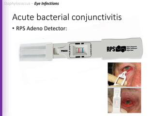 Acute bacterial conjunctivitis
• RPS Adeno Detector:
Staphylococcus – Eye Infections
 