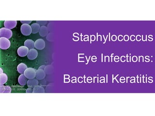 Staphylococcus
Eye Infections:
Bacterial Keratitis
 