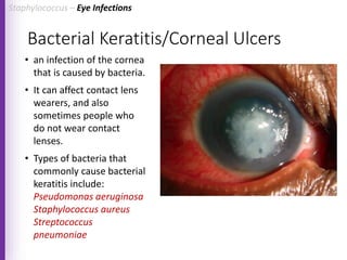 Bacterial Keratitis/Corneal Ulcers
• an infection of the cornea
that is caused by bacteria.
• It can affect contact lens
wearers, and also
sometimes people who
do not wear contact
lenses.
• Types of bacteria that
commonly cause bacterial
keratitis include:
Pseudomonas aeruginosa
Staphylococcus aureus
Streptococcus
pneumoniae
Staphylococcus – Eye Infections
 