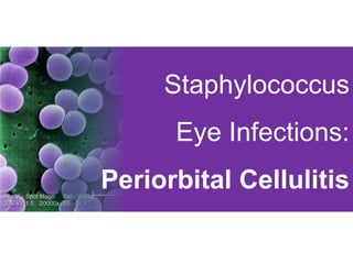 Staphylococcus
Eye Infections:
Periorbital Cellulitis
 