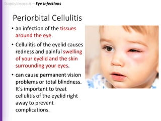 Periorbital Cellulitis
• an infection of the tissues
around the eye.
• Cellulitis of the eyelid causes
redness and painful swelling
of your eyelid and the skin
surrounding your eyes.
• can cause permanent vision
problems or total blindness.
It’s important to treat
cellulitis of the eyelid right
away to prevent
complications.
Staphylococcus – Eye Infections
 