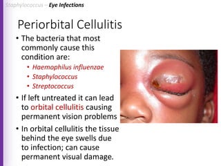 Periorbital Cellulitis
• The bacteria that most
commonly cause this
condition are:
• Haemophilus influenzae
• Staphylococcus
• Streptococcus
• If left untreated it can lead
to orbital cellulitis causing
permanent vision problems
• In orbital cellulitis the tissue
behind the eye swells due
to infection; can cause
permanent visual damage.
Staphylococcus – Eye Infections
 