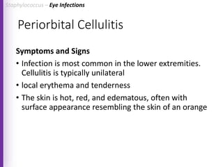 Periorbital Cellulitis
Symptoms and Signs
• Infection is most common in the lower extremities.
Cellulitis is typically unilateral
• local erythema and tenderness
• The skin is hot, red, and edematous, often with
surface appearance resembling the skin of an orange
Staphylococcus – Eye Infections
 