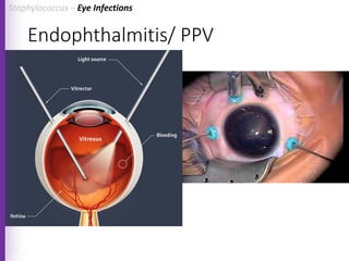 Endophthalmitis/ PPV
Staphylococcus – Eye Infections
 