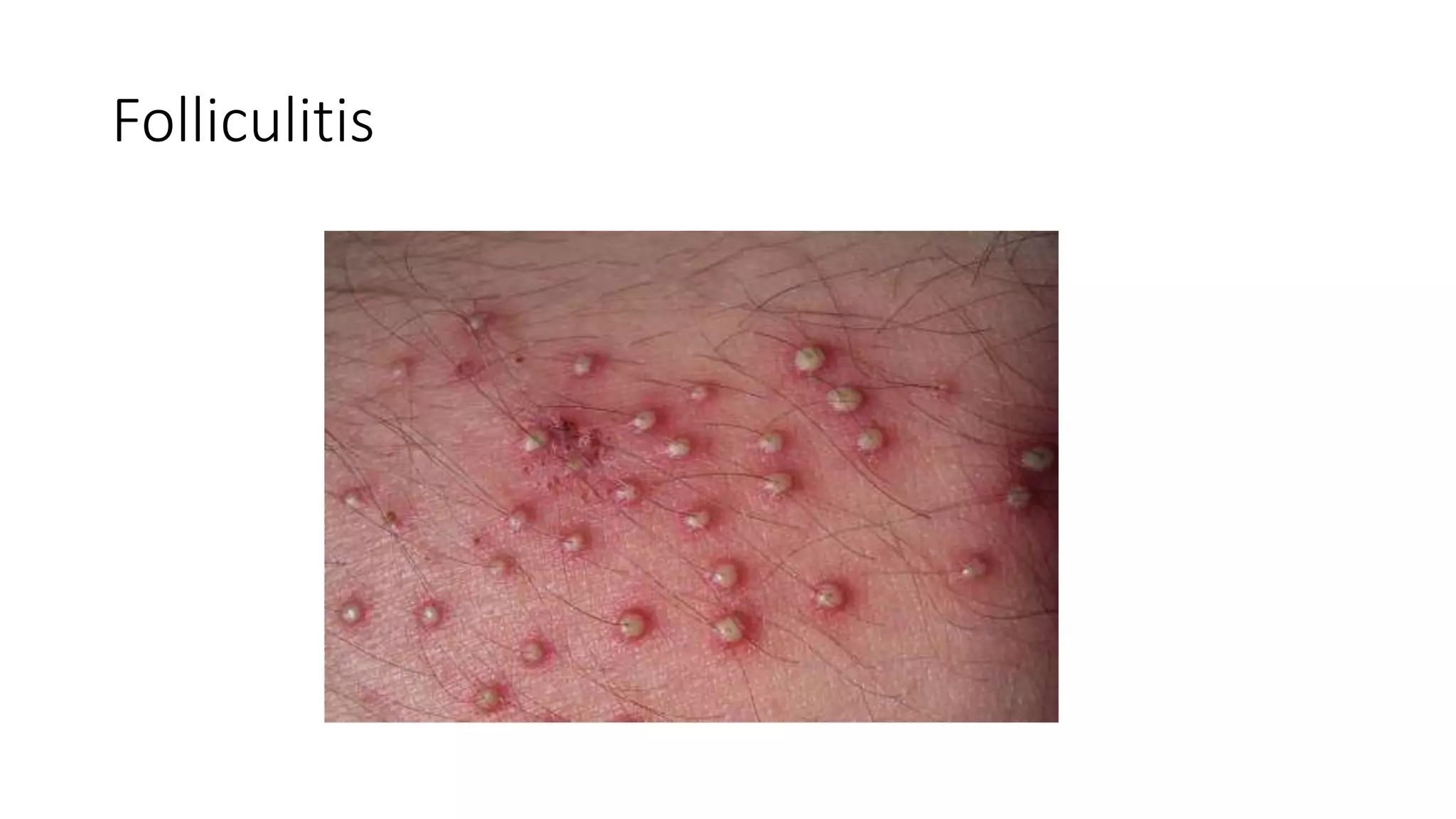 Folliculitis
 
