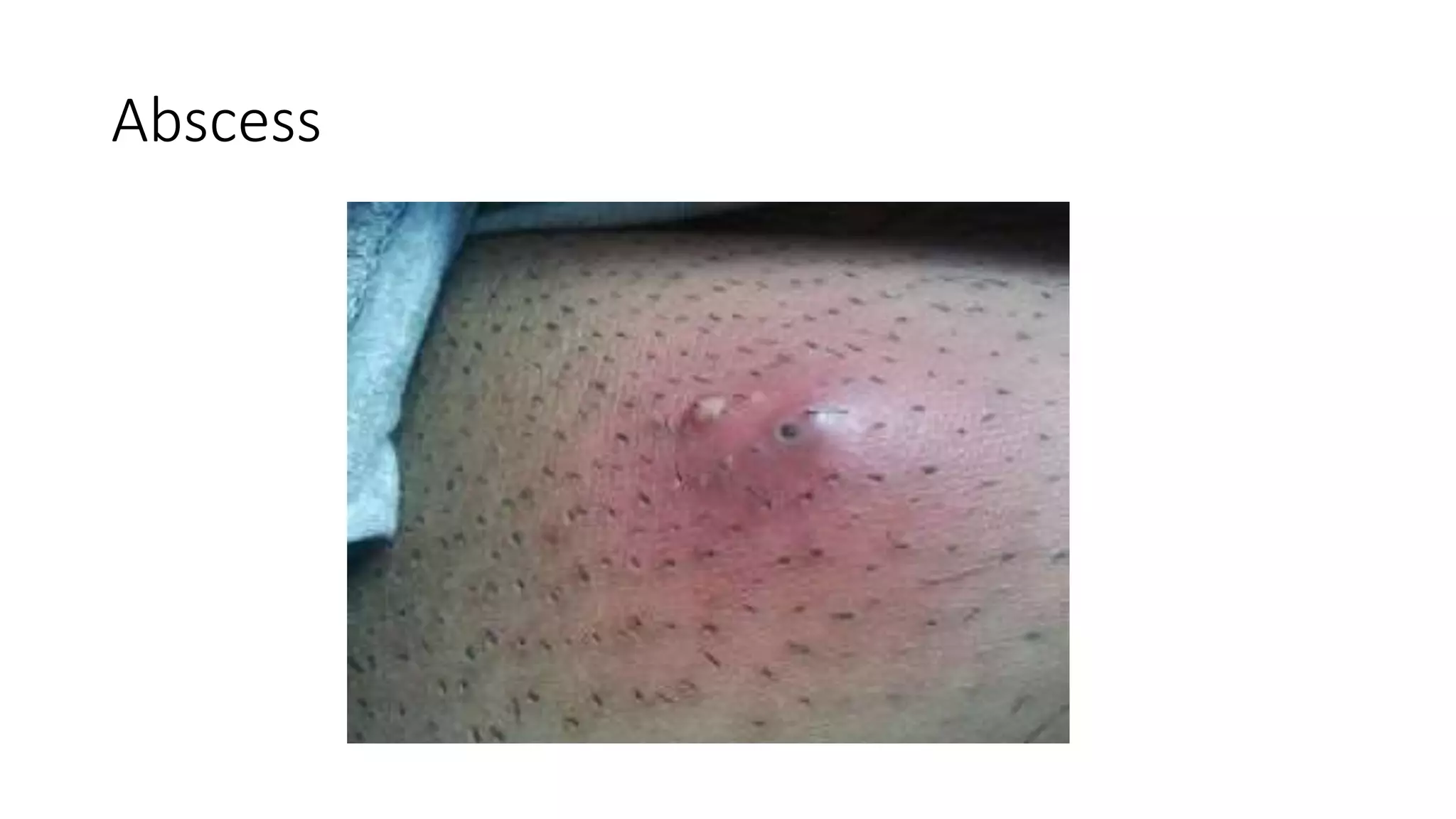 Abscess
 